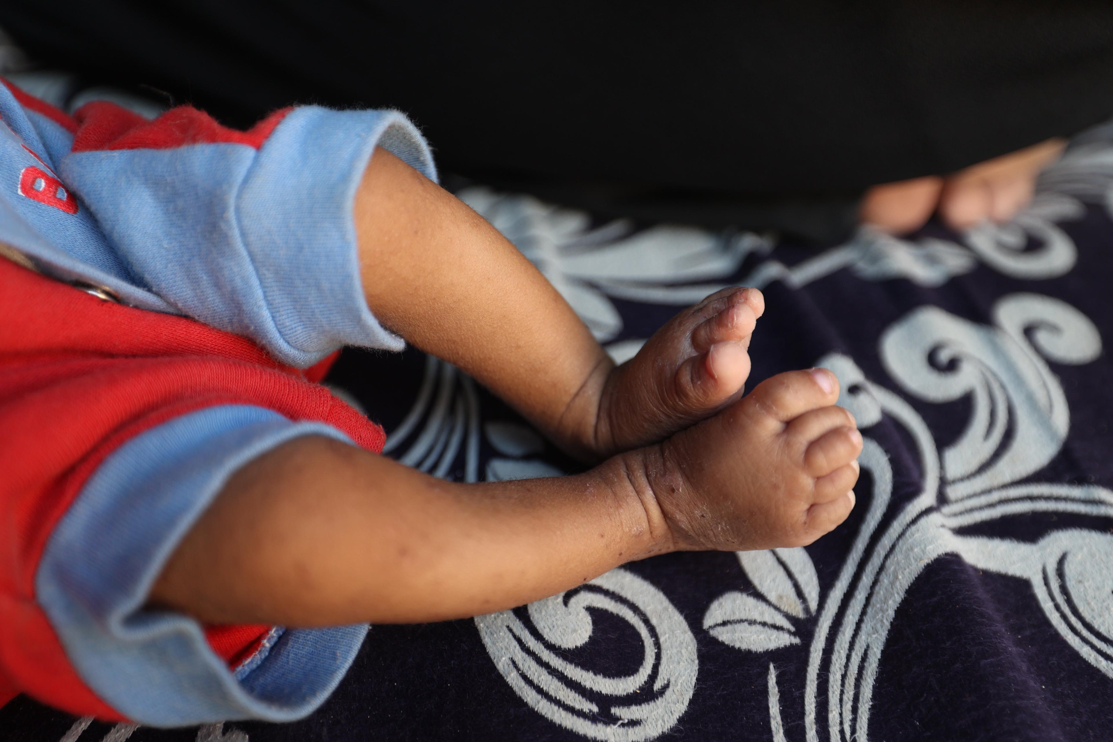 Een close up foto van de voeten van Ali, twee jaar oud, die lijdt aan acute ondervoeding.